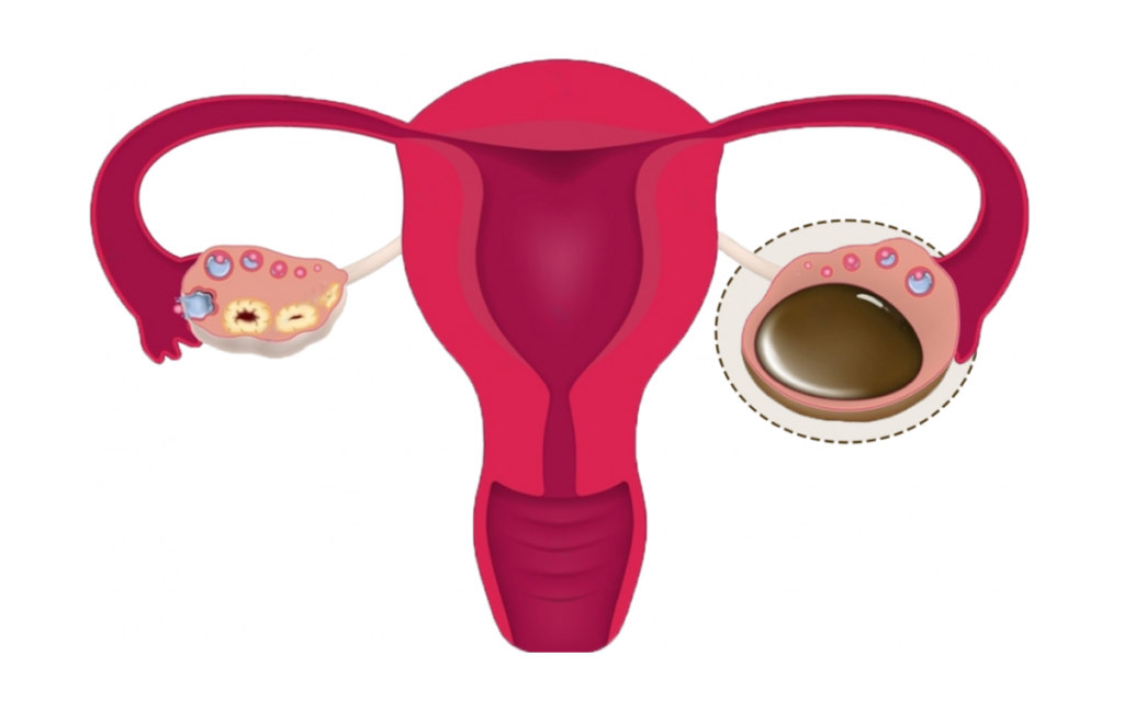 Chocolate Cyst Treatment in Jayanagar