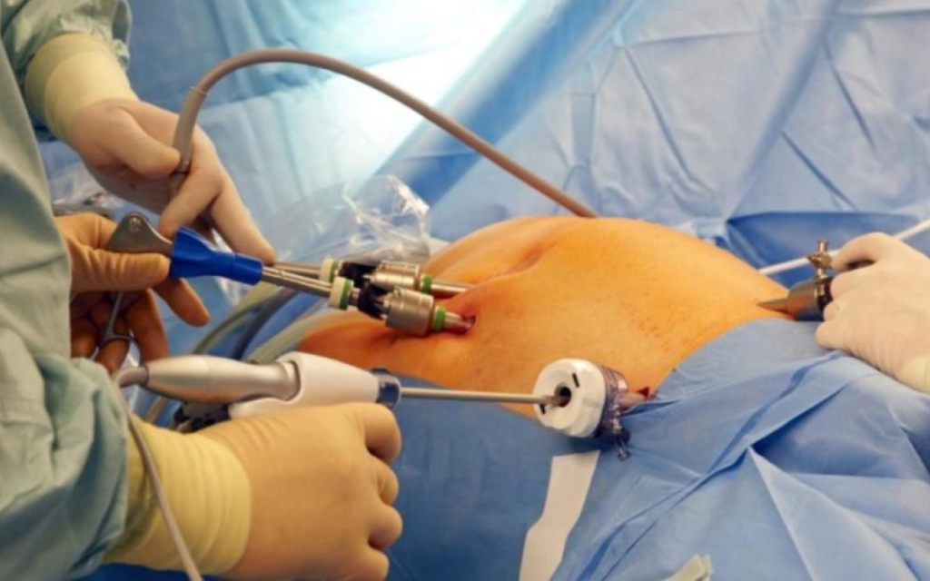 Hystero-Laparoscopy in Jayanagar