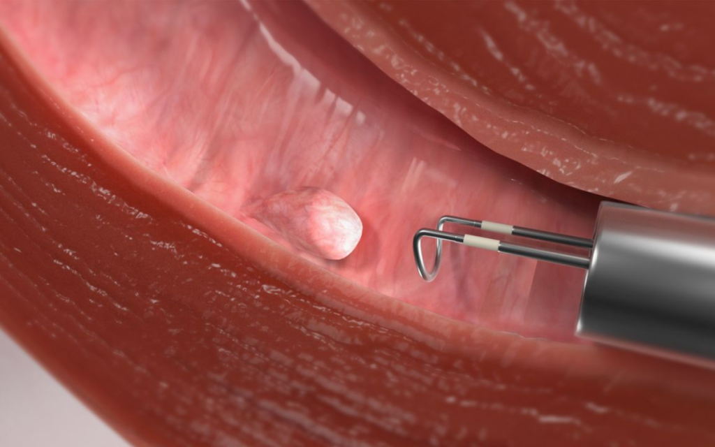 Hysteroscopic Polypectomy in Jayanagar