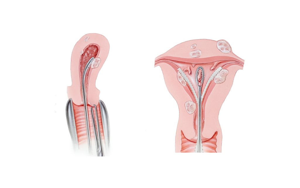 Hysteroscopic Spetal Resection