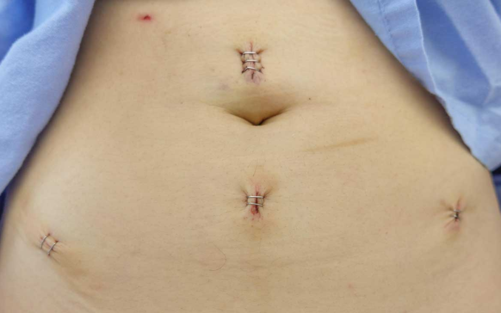 Laparoscopic Myomectomy Treatment in Jayanagar