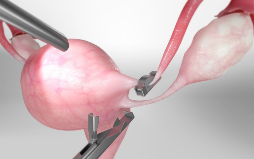 Hysteroscopic Tubal Cannulation in Jayanagar