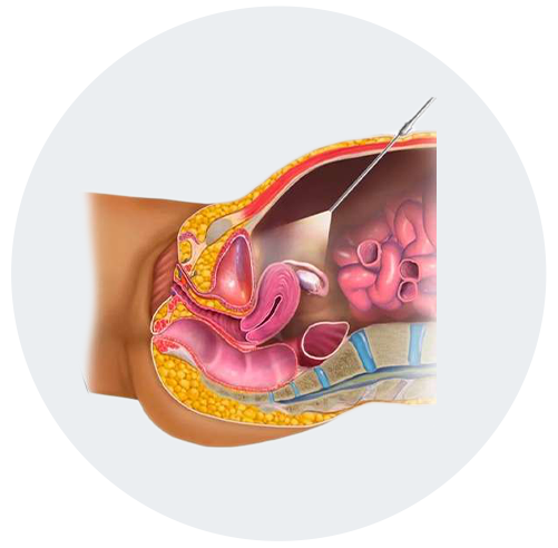 IVF Treatment in Gottigere